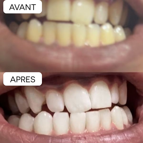 🦷BANDES POUR BLANCHIR LES DENTS JAUNES EN 30 MINUTES⏱️