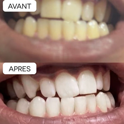 🦷BANDES POUR BLANCHIR LES DENTS JAUNES EN 30 MINUTES⏱️
