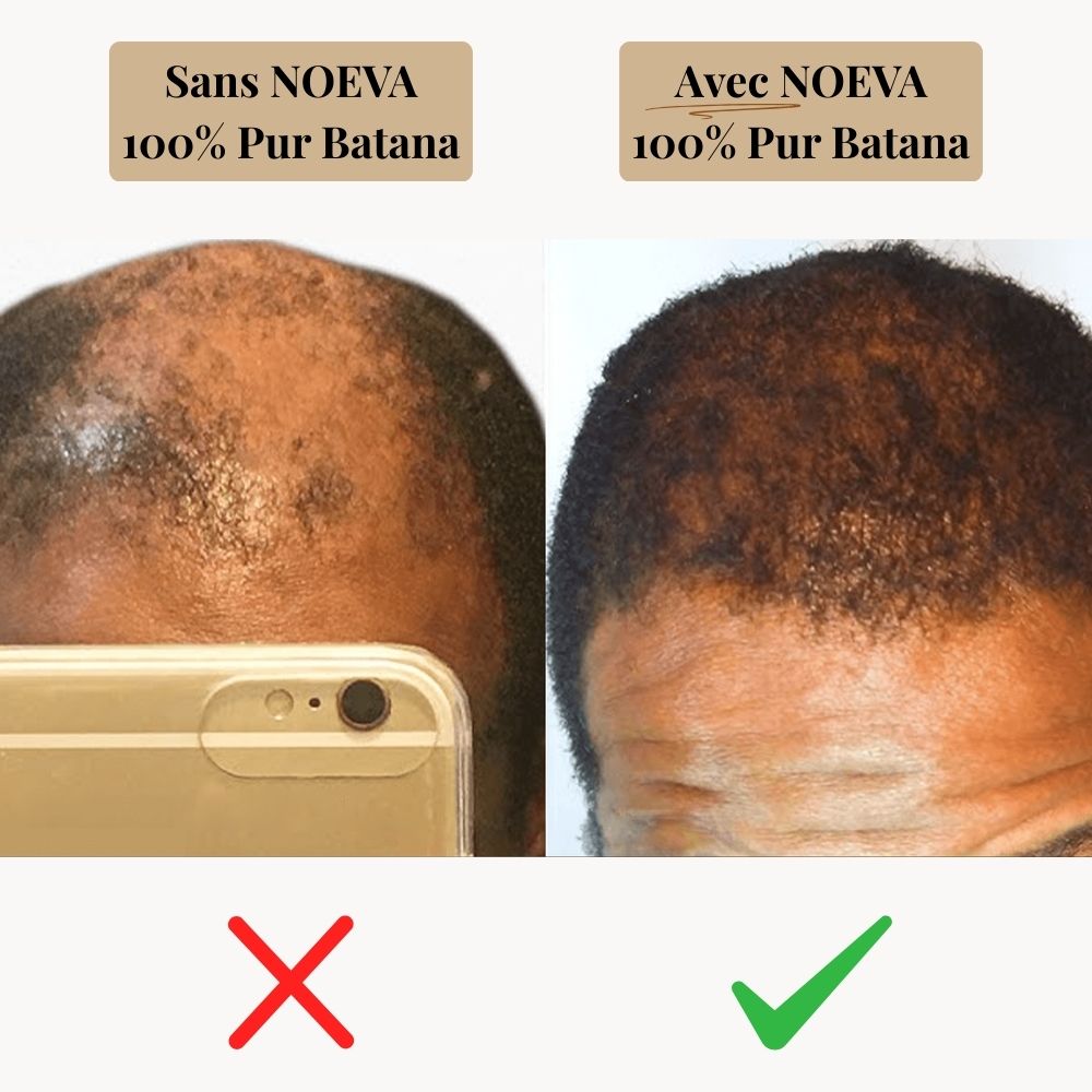 HUILE MIRACLE DE BATANA™  POUR LA POUSSE ET LA REPOUSSE DE VOS CHEVEUX
