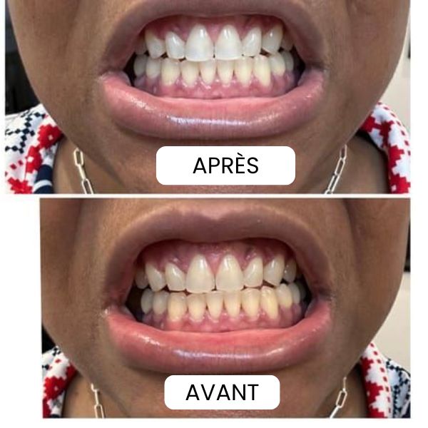 🦷BANDES POUR BLANCHIR LES DENTS JAUNES EN 30 MINUTES⏱️
