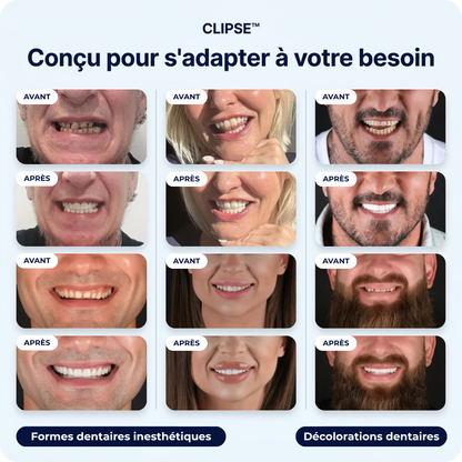 Facettes Dentaires Clipse — Vue 5