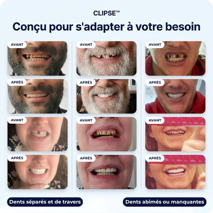 Facettes Dentaires Clipse — Vue 4