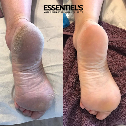 SOIN DE PIED - MASQUE POUR RETROUVER VOS PIEDS DE BÉBÉ EN 4 JOURS