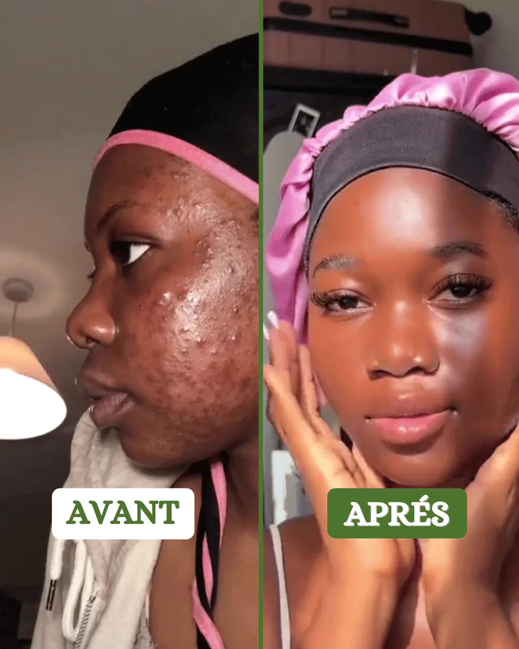 APPAREIL ÉPURATEUR DE VISAGE ✨💧 – ÉLIMINE L’ACNÉ, L’EXCÈS DE SÉBUM & LES GRAISSES 😍